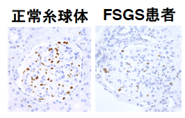 ヒト正（左）常、FSGS患者（右）の糸球体におけるMAFB発現