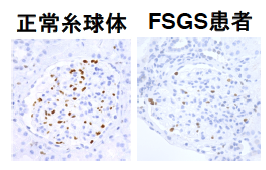 ヒト正(左)常、FSGS患者(右)の糸球体におけるMAFB発現