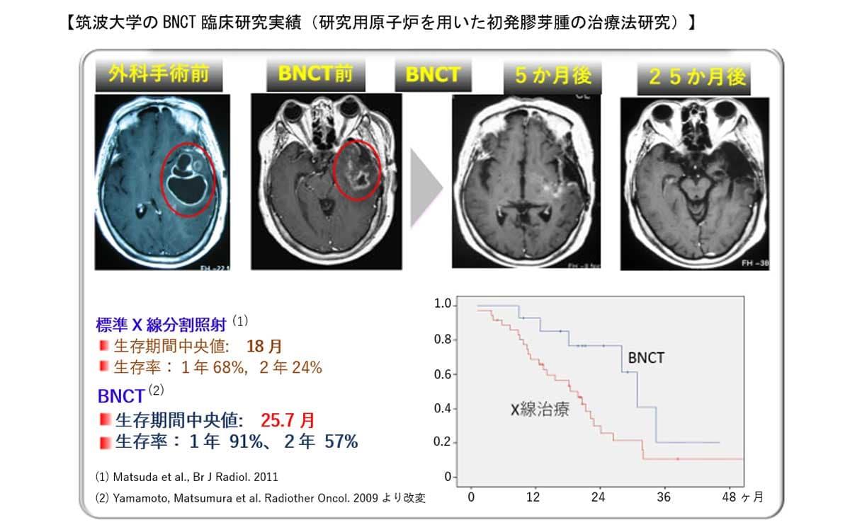 筑波大学のBNCT臨床研究実績（研究用原子炉を用いた初発膠芽腫の治療法研究）